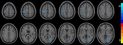 Neural activity changes in first-episode, drug-naïve patients with major depressive disorder after transcutaneous auricular vagus nerve stimulation treatment: A resting-state fMRI study